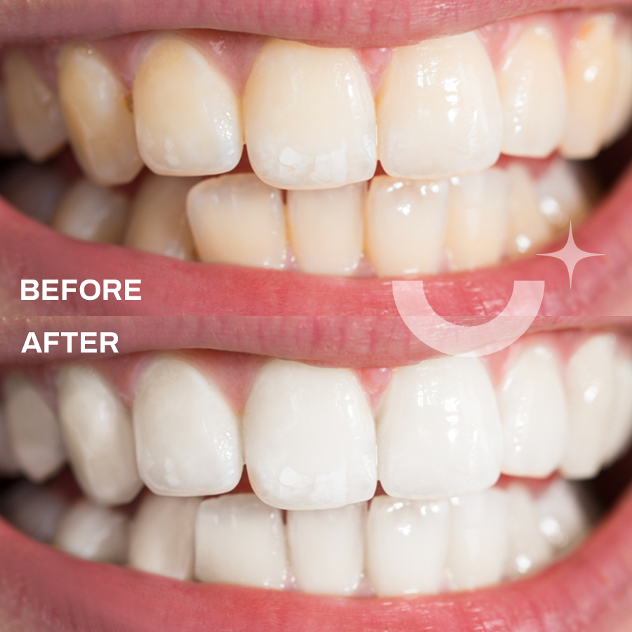 Visual proof of Whitening Laboratory's effectiveness, with the pre-treatment discolored teeth and post-treatment radiant white teeth.