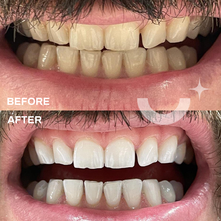 Dramatic whitening results with Whitening Laboratory, with the first image displaying yellowish teeth and the second showing a brighter smile.