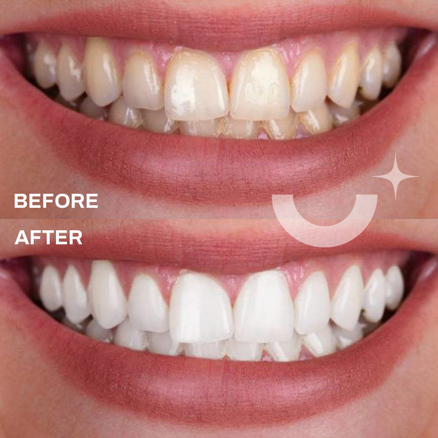 Before and after comparison using Whitening Laboratory Strips, showing teeth before treatment and significantly whiter after.