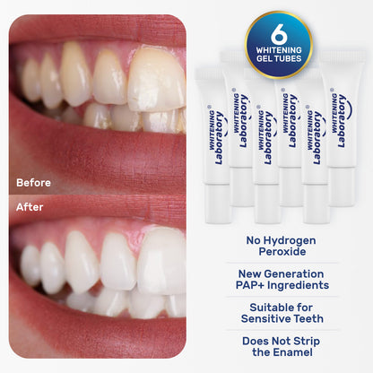 Before and after photos showing the effectiveness of Whitening Laboratory's teeth whitening treatment, with a focus on the gentle formula suitable for sensitive teeth.